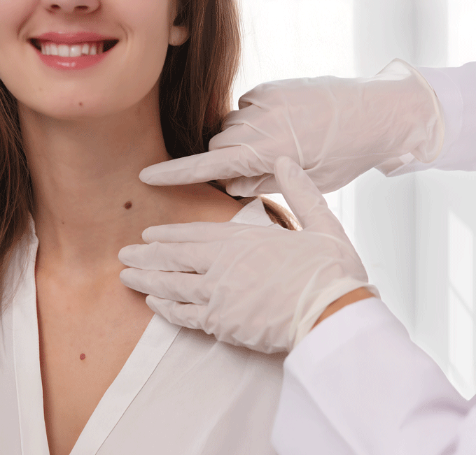 Skin Tag Removal Journey