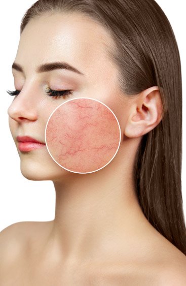 Overview of Rosacea