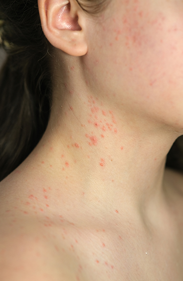 Overview of Skin Allergies