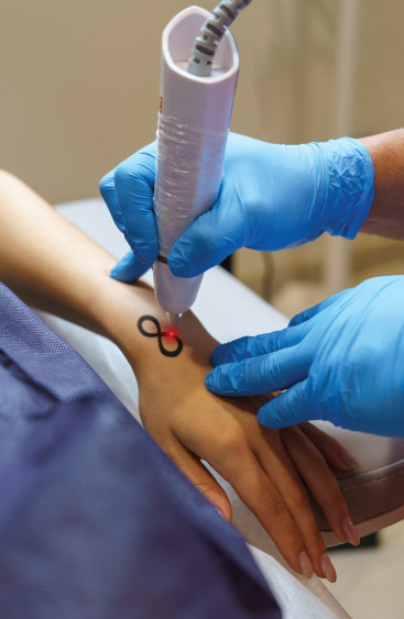 Overview of Tattoo Removal