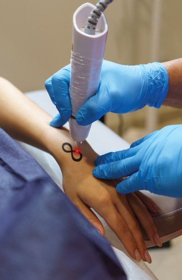 Overview of Tattoo Removal