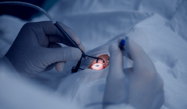 Eye test for cataract surgery