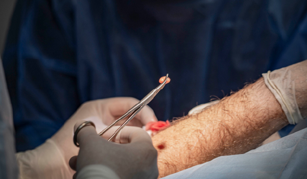 Doctor checking lipoma on a patient