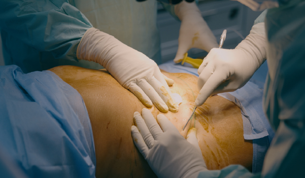 Removing fat during Liposuction