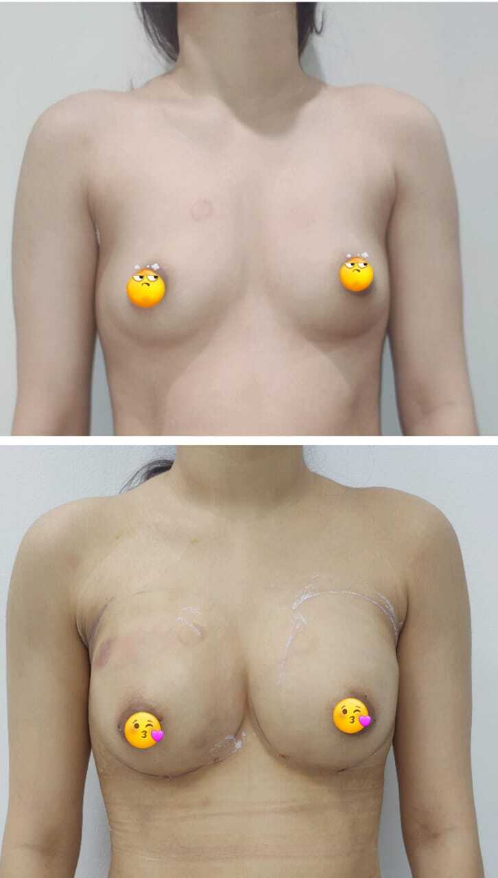 Small Breasts before the breast augmentation surgery