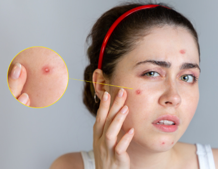 know-more-about-Acne Control-treatment-in-Delhi