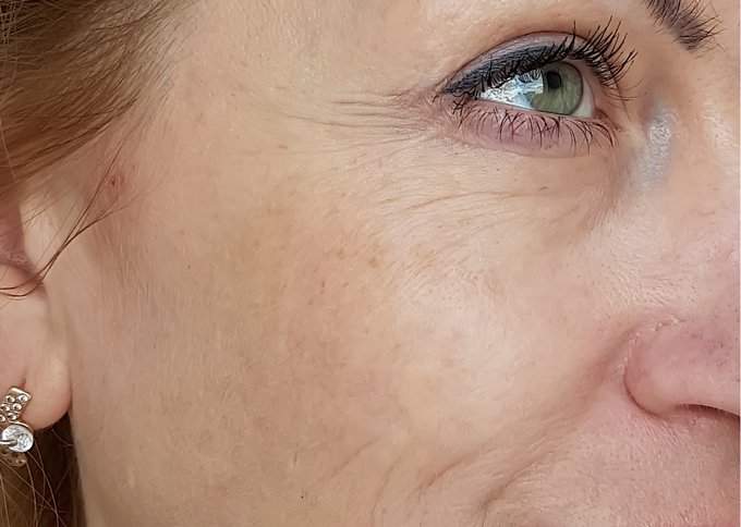 Before treatment 2