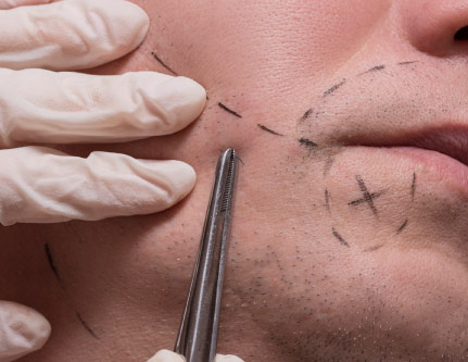 know-more-about-Beard Transplant-treatment-in-Pune