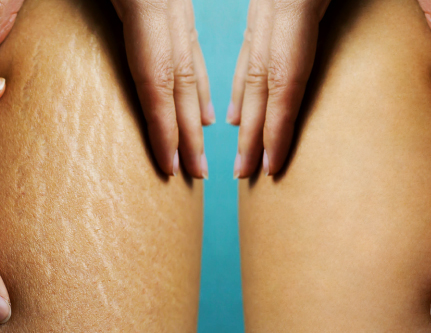 know-more-about-Burns and Stretch Marks-treatment-in-Delhi
