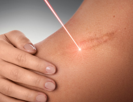 burns and stretch marks