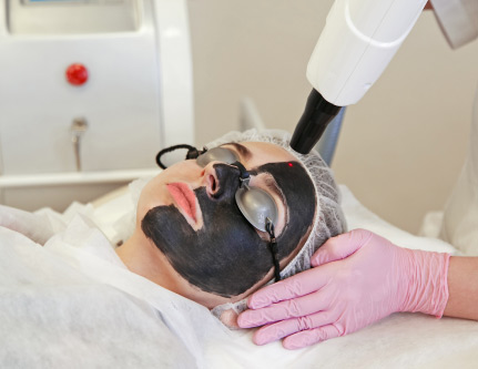 carbon laser peel treatment