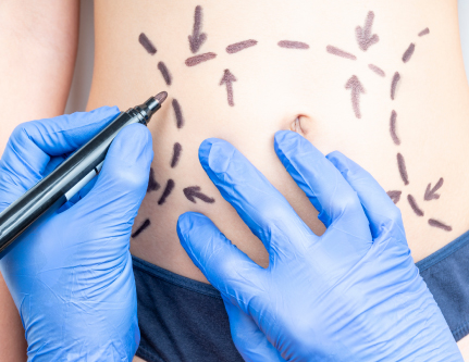 know-more-about-Cool Sculpting Fat Loss-treatment-in-Delhi