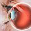 Diabetic Retinopathy Surgery - Advanced laser technology used by eye specialist