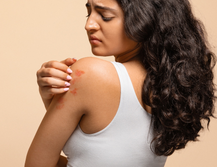 know-more-about-Eczema-treatment-in-Delhi