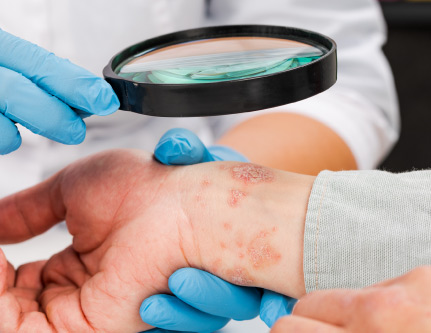 eczema treatment