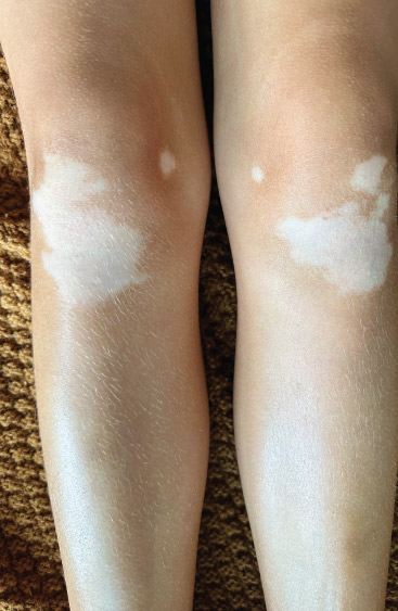 Overview of Excimer Laser Treatment