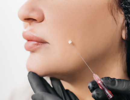 face threadlift treatment