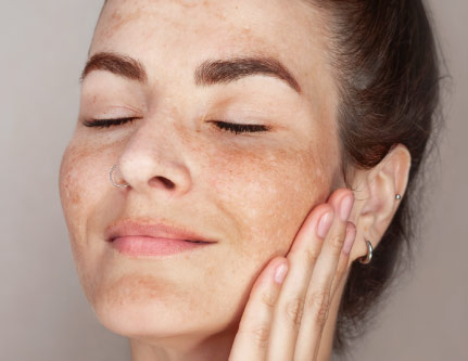 know-more-about-Hyperpigmentation-treatment-in-Delhi