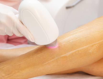 know-more-about-Intense Clarity Laser-treatment-in-Delhi