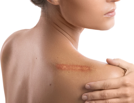 know-more-about-Keloid Scar-treatment-in-Delhi