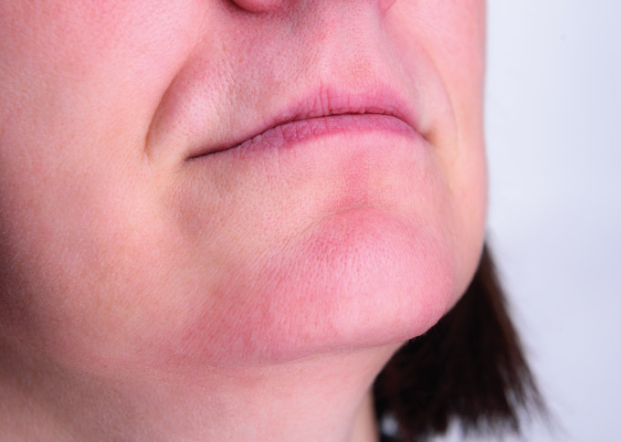 After treatment 2