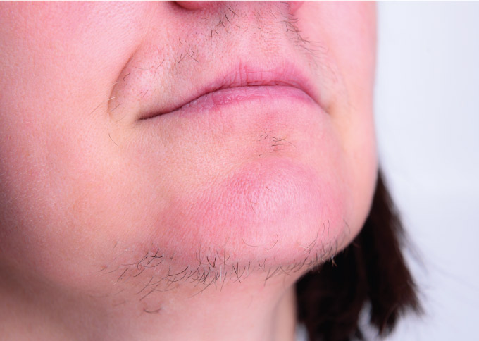 Before treatment 2