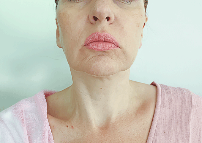 Before treatment 1