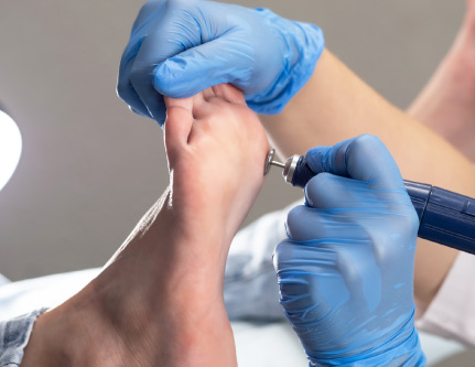 paring treatment