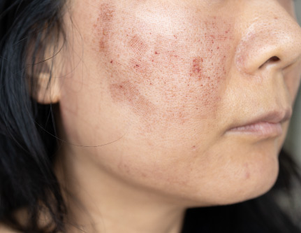 pigmentation treatment