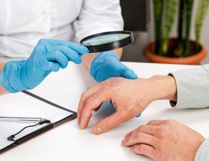 psoriasis treatment 