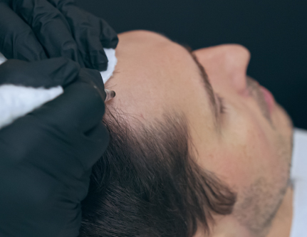 know-more-about-Scalp Micropigmentation-treatment-in-Delhi