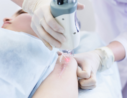 scar removal treatment