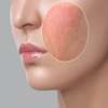 Skin Allergies