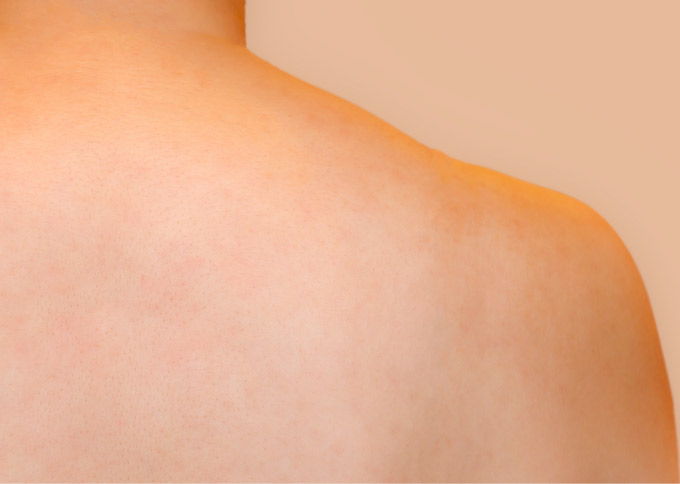 After treatment 2