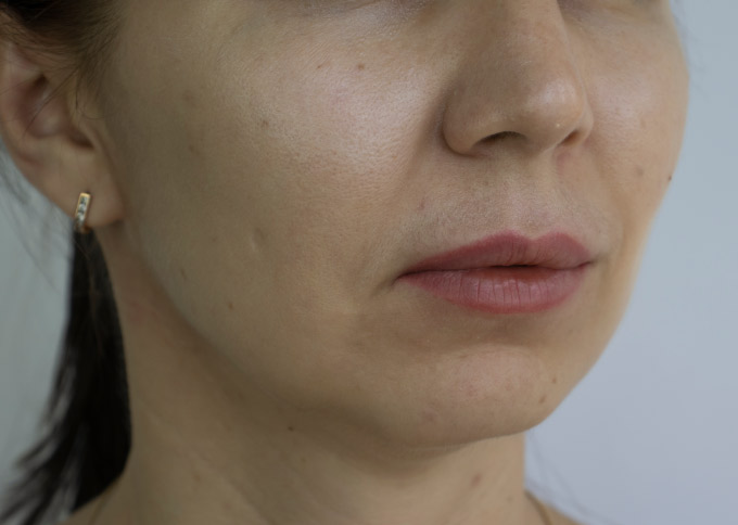 Before treatment 1