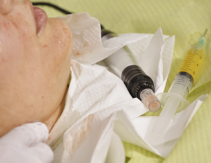 vampire facial treatment