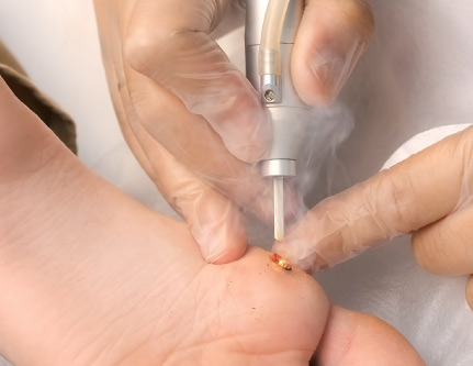 warts treatment