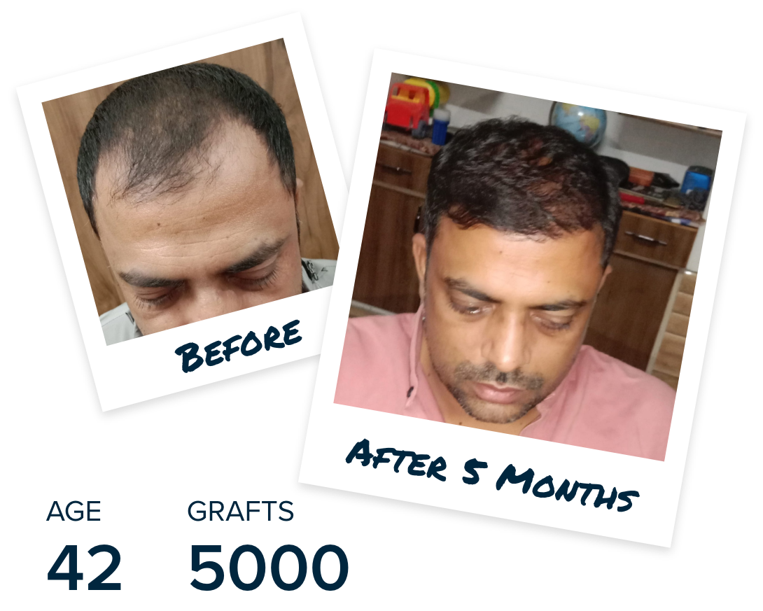 Martinick Hair - The shedding phase of a patient seeing our doctor 2 weeks  post hair transplant procedure. Shedding of hair grafts can be noticed  anywhere between 1-5 weeks after the hair