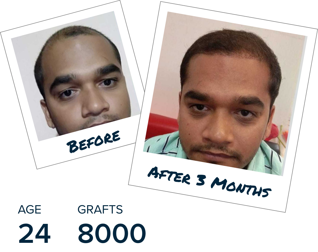 Hair Transplant Recovery Timeline | 0 - 14 Months Photos
