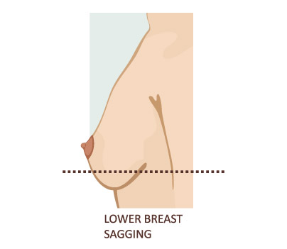 Female breast sagging Royalty Free Vector Image