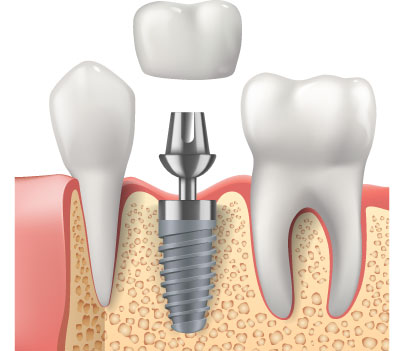 Dental Implant in India