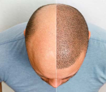 Trusted & Best Hair Transplant Treatment for Men/Women in India - Pristyn  Care