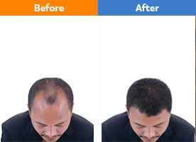 Hair Transplant Surgery Cost in Bangalore - Pristyn Care