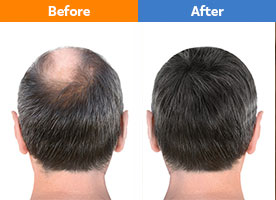 Hair Transplant Surgery Cost in Chennai - Pristyn Care
