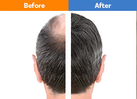 Before & After Hair Transplant Results: 3 Month