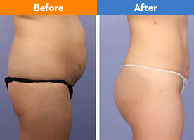 Liposuction in Noida, Fat Removal Treatment