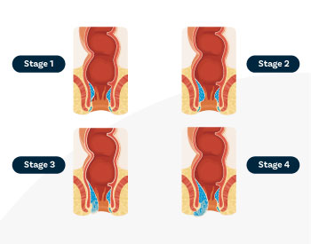 Piles Treatment in Delhi | Experienced Doctors for Piles Laser Surgery