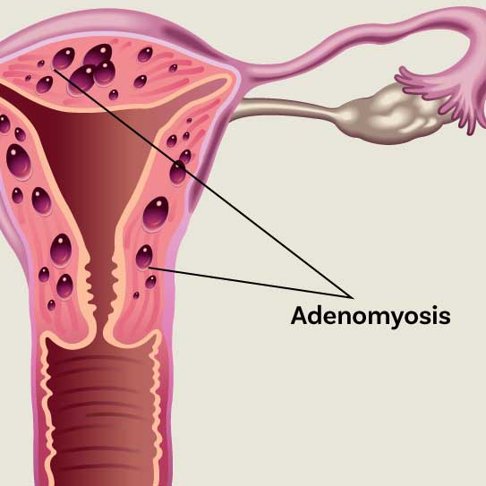 Adenomyosis
