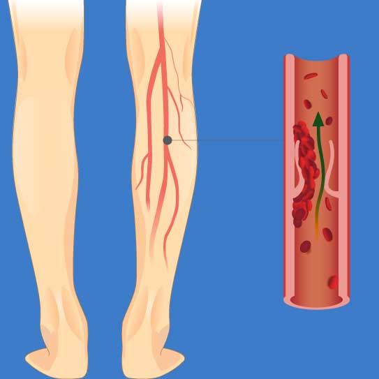know-more-about-Deep Vein Thrombosis-treatment-in-Noida