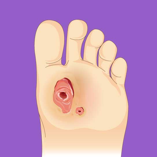 know-more-about-Diabetic Foot Ulcers-treatment-in-Nashik